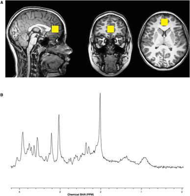 Children With Dyslexia and Typical Readers: Sex-Based Choline Differences Revealed Using Proton Magnetic Resonance Spectroscopy Acquired Within Anterior Cingulate Cortex